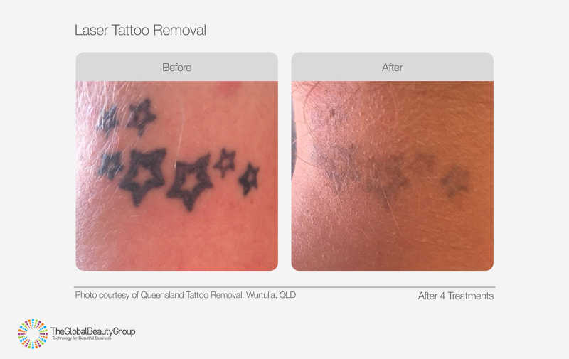 Laser Tattoo Removal Before & After 03 