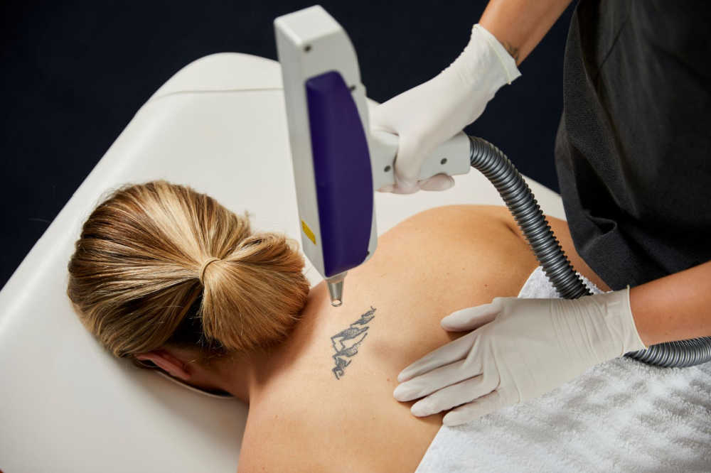 Laser Tattoo Removal In-Use 